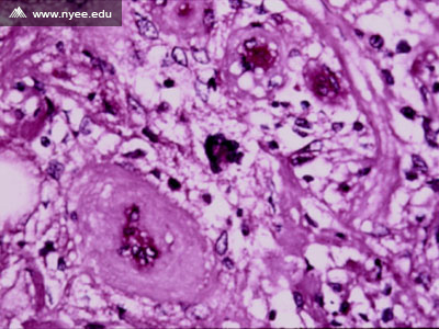 Erdheim-Chester Disease: Histology - NYEE
